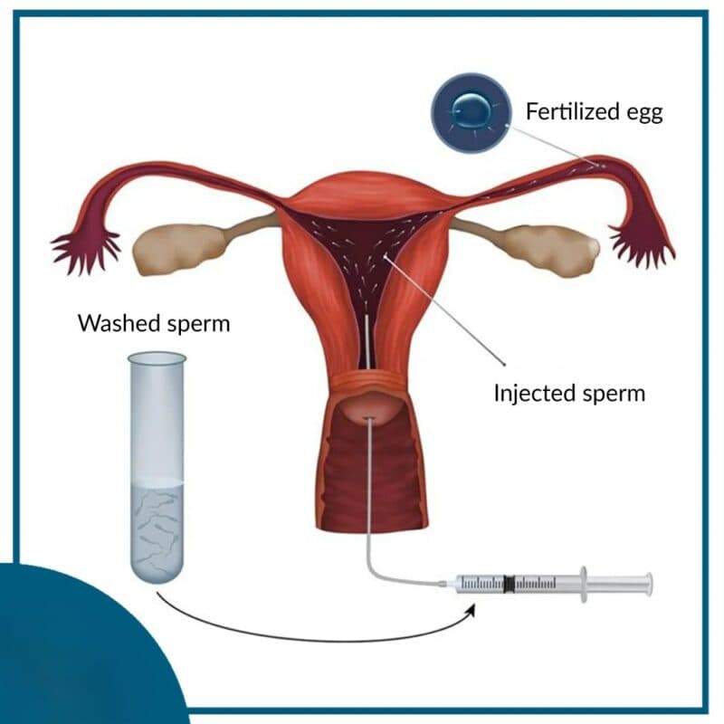 Minimally Invasive Fertility Treatments