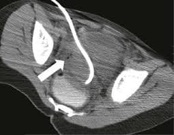 Image-Guided Drainage Procedures