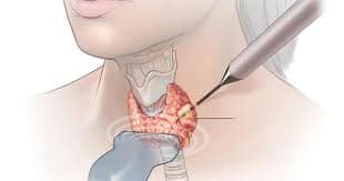 Thyroid Nodules