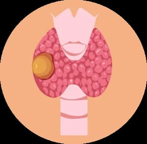 Symptoms of Thyroid Nodules