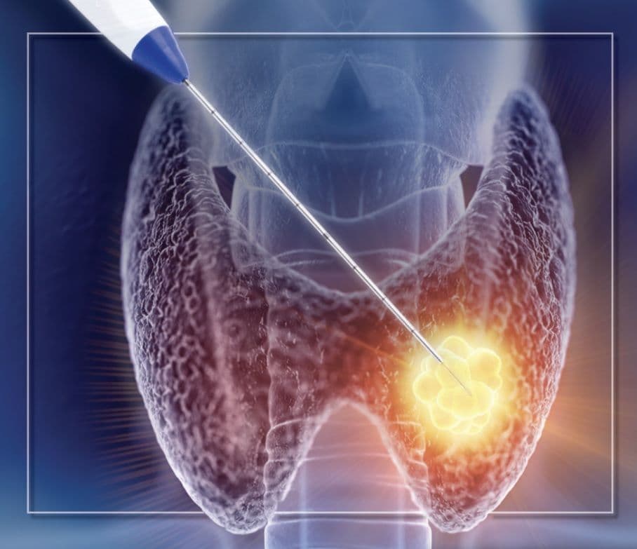 Thyroid Ablation
