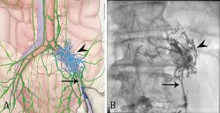 Lymphangiography and Lymphatic Interventions