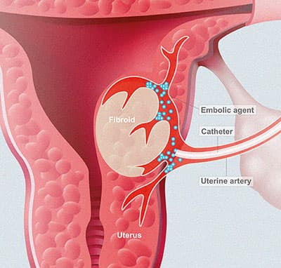 Uterine Fibroids