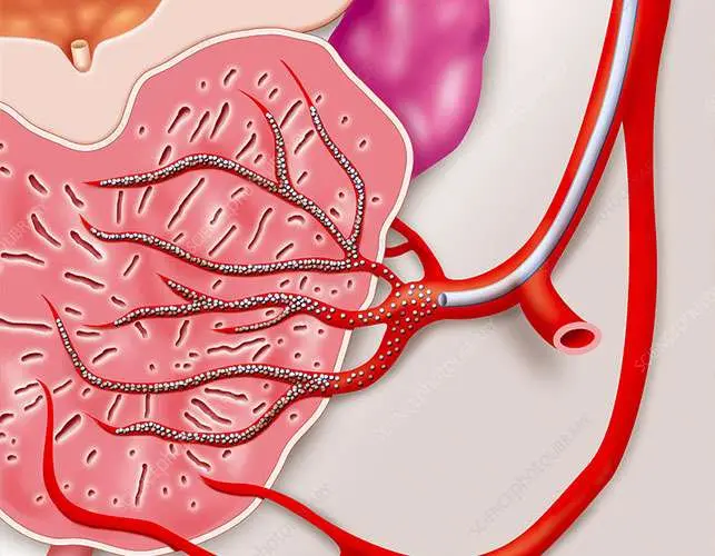 Enlarged Prostate