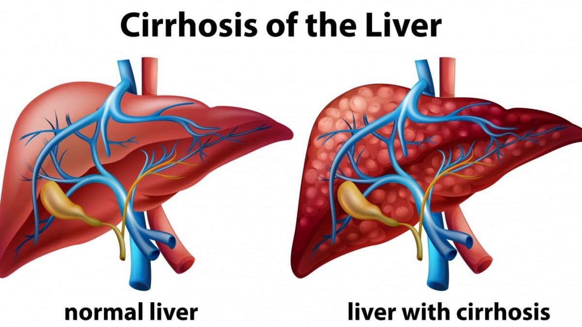 Liver Cirrhosis