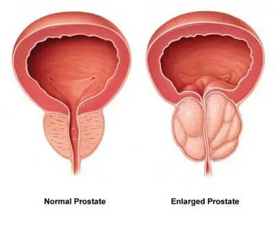 BPH (Enlarged Prostate)
