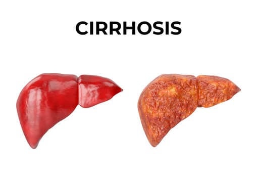 Liver Tumor & Cirrhosis