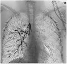 Hemoptysis