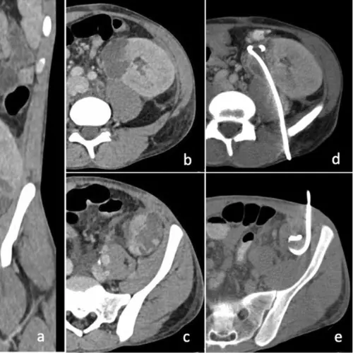 Abdominal & Pelvic Collections