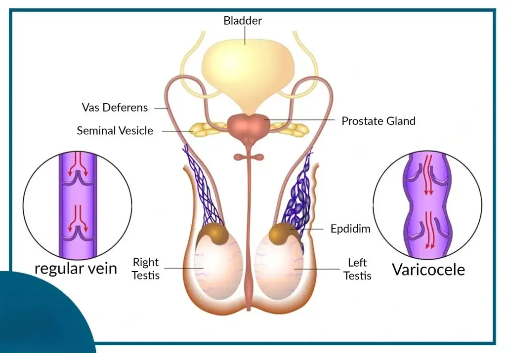 Treatment for Varicocele