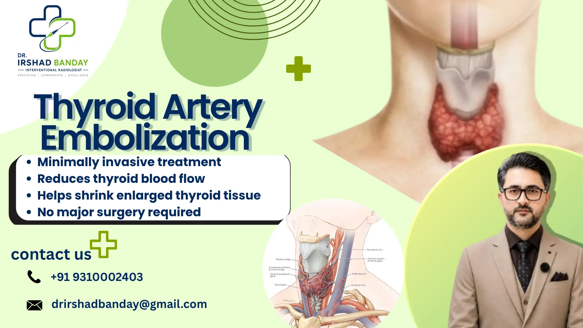 Thyroid Artery Embolization
