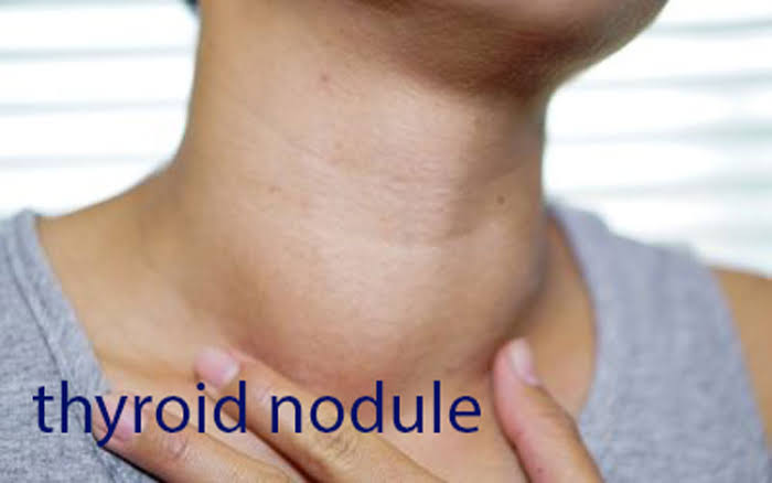 What causes thyroid nodules?