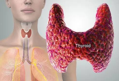 Thyroid Nodules
